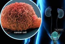 ما هو سرطان المثانة؟