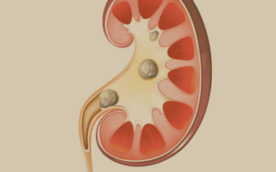 حصوات الكلي