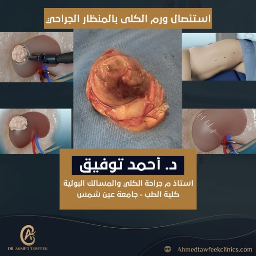 ورم على الكلى