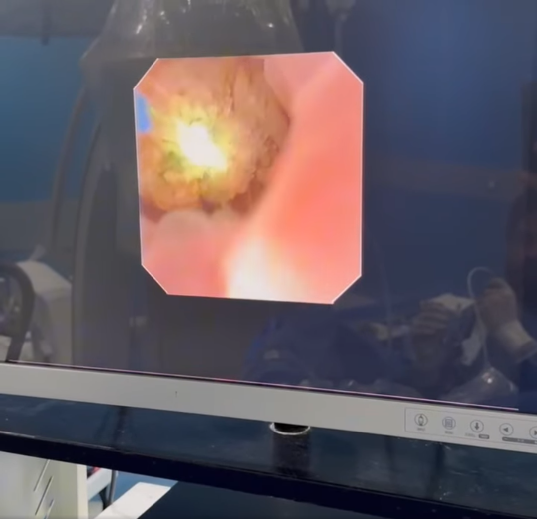 تفتيت حصوة الحالب بالمنظار المرن والليزر